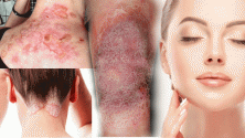 Teachlr.com - Certificate In Skin Disorders Alternative Therapy Treatment